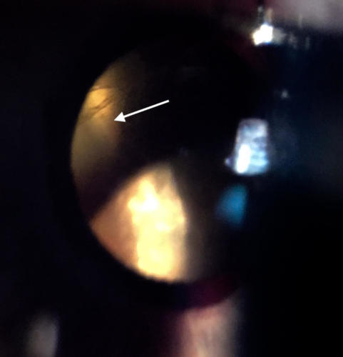 Retinal detachment - old - visible behind the subluxated crystalline lens